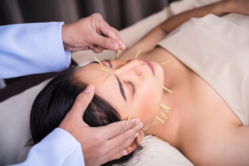 cosmetic acupuncture auckland