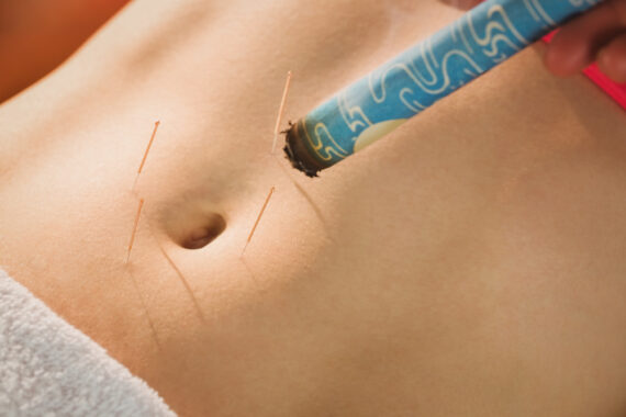 young-woman-getting-acupuncture-treatment