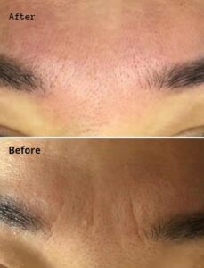 forehead wrinkles frown lines firming case1
