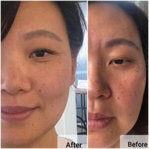 face rejuvenation acupuncture face acupuncture case view