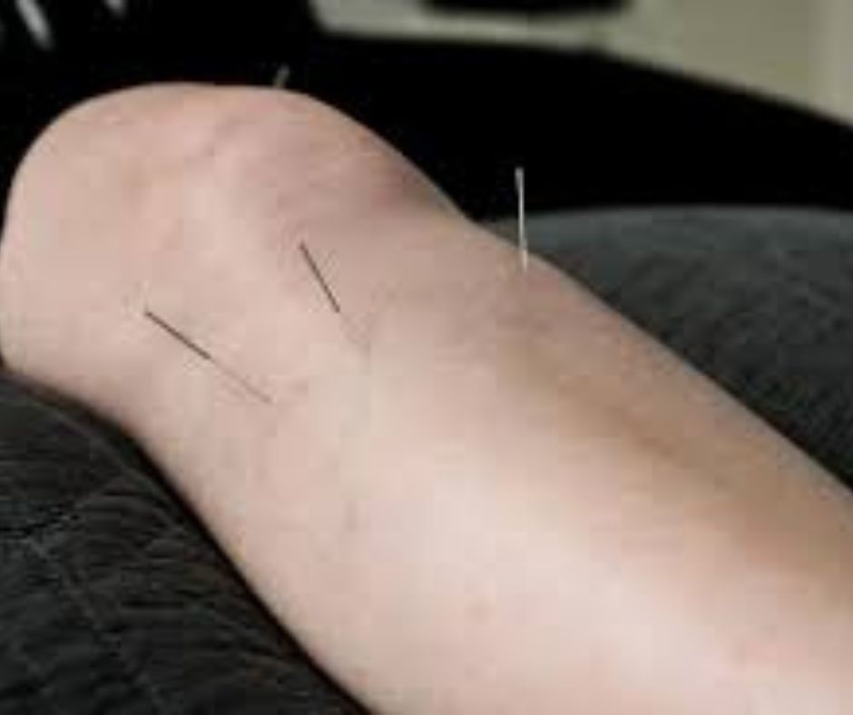 acupuncture treatment for pain relief