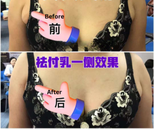 副乳