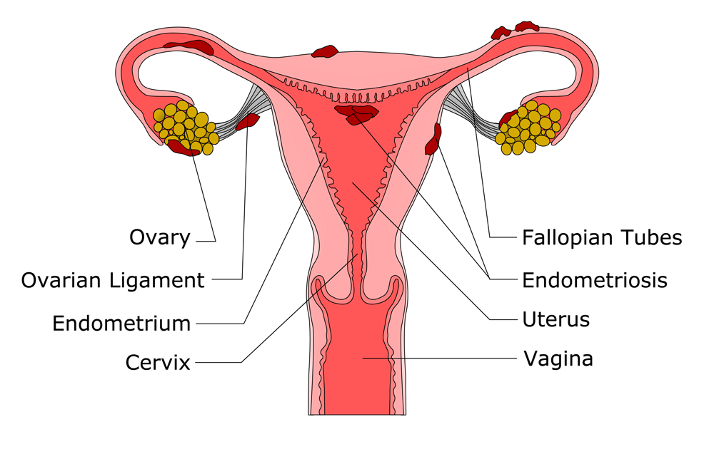 endometriosis